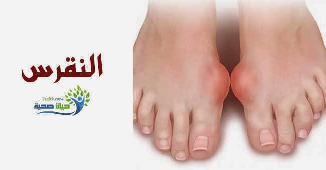 مرض النقرس - اعراضه وعلاجه وطرق الوقايه منه 1072 3