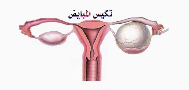 العلامات التي تؤدي إلي تكيس المبايض ماهي اعراض تكيس المبايض 3921 2