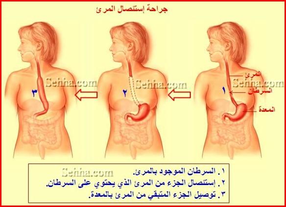 اعراض سرطان المرئ - تعرف على مرض سرطان المرئ و اعراضه 305 1