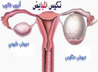 العلامات التي تؤدي إلي تكيس المبايض ماهي اعراض تكيس المبايض 3921 3