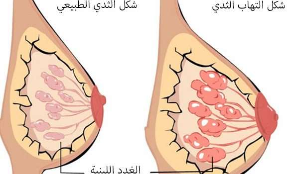 التهاب الثدي- يجب عليك الحظر 118