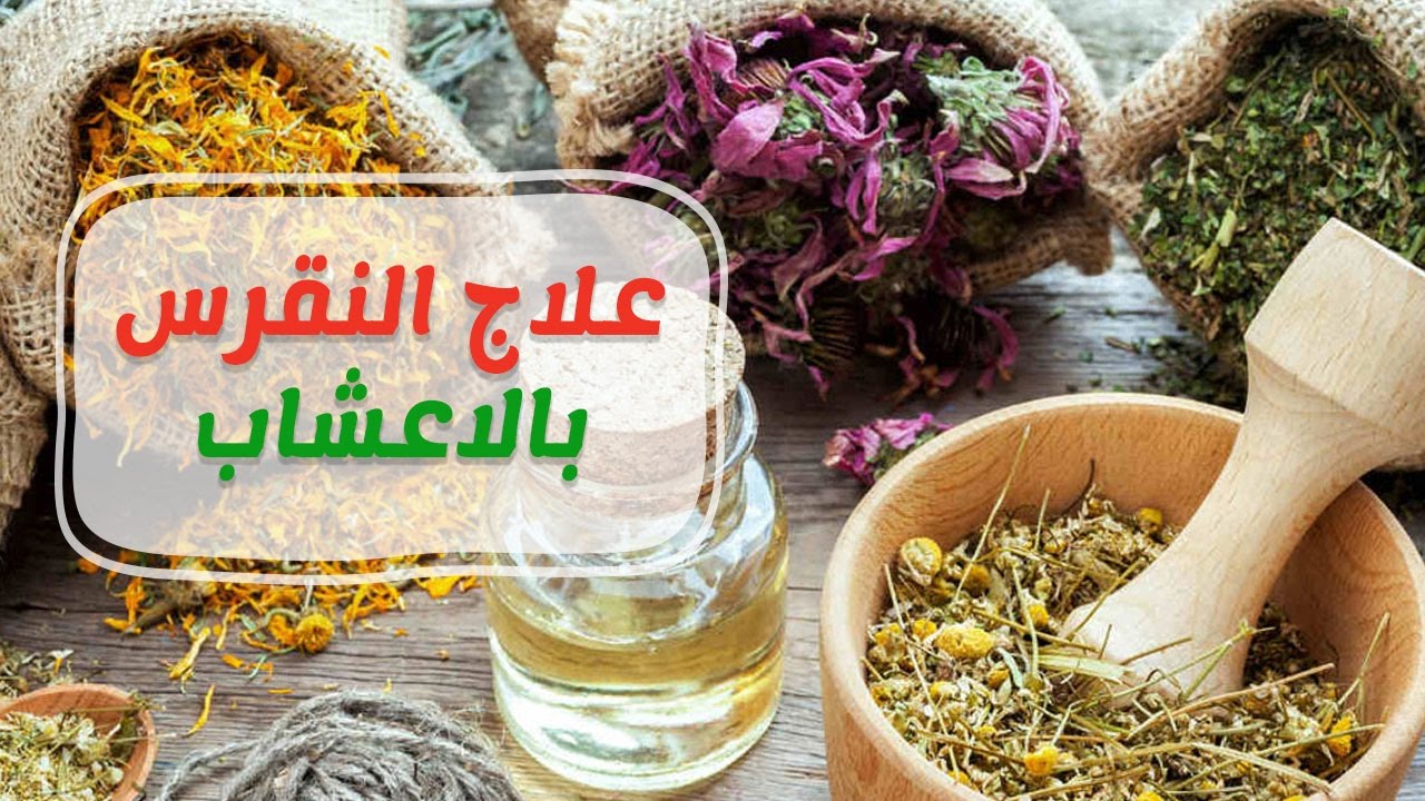 علاج النقرس بالاعشاب - ما هو علاج النقرس 1681 2