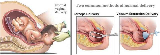 صور للولاده - اساليب الولادة المختلفة 5780 5