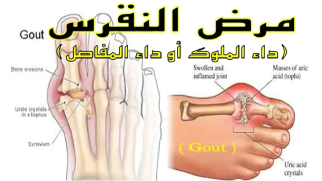 علاج النقرس بالاعشاب - ما هو علاج النقرس 1681 1