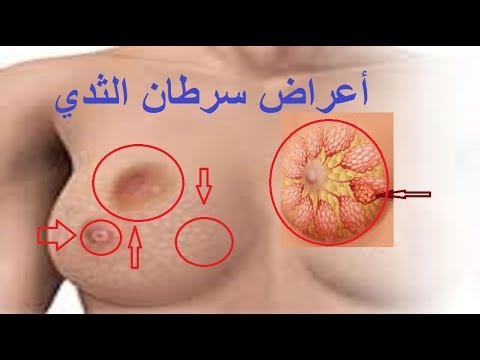 مرض سرطان الثدي - اسبابه وعلاجه وكيف تكتشفينه- 6088 1