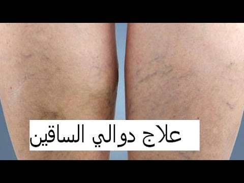 علاج الدوالي - علاجات منزليه طبيعيه للدوالي 6121 1