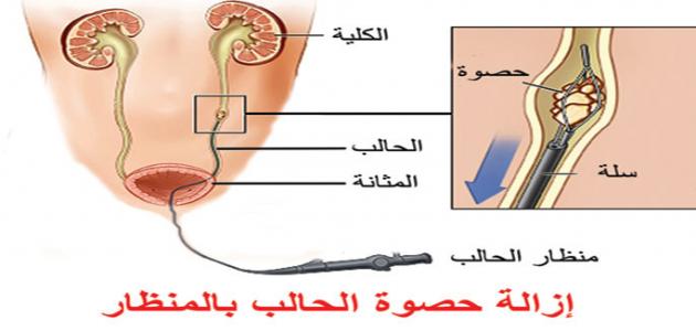 علامات نزول الحصوة- ازاي تعرفي ان دي حصوه 11476 2