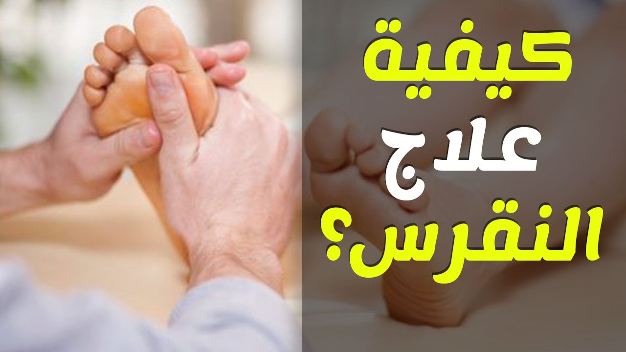 اعراض النقرس - ماهو النقرس وكيفيه علاجه 5653 2