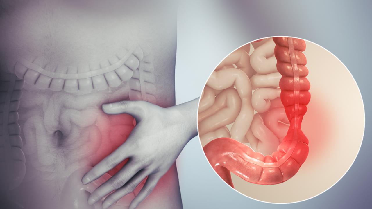 اعراض القولون المتهيج 11573