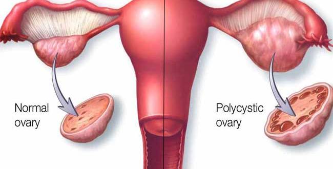 علاج التكيس , تكيس المبايض علاجه الحرص والاهتمام