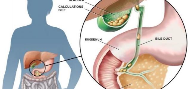 اعراض المرارة - الامراض المزمنه و اعراضها 2530 1