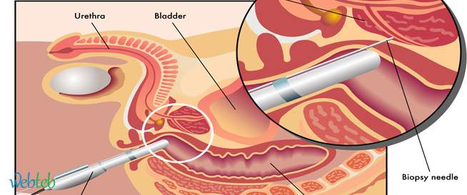 علاج البروستاتا , مرض يصيب الرجال