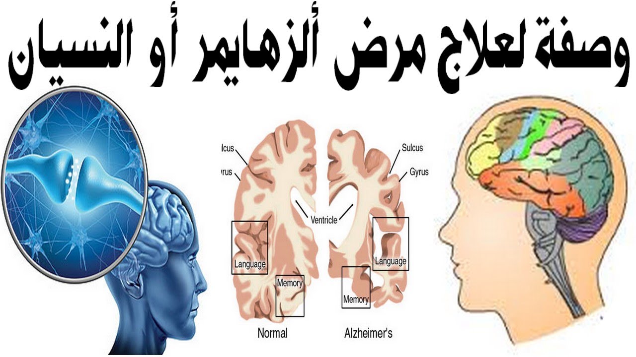 علاج النسيان , ما هو علاج النسيان