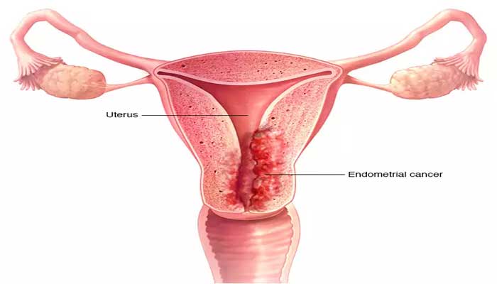 اعراض سرطان الرحم , سرطان الرحم اسبابه وعلاجه