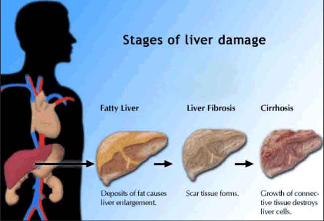 علاج تليف الكبد - تليف الكبد انتشر بسبب الجهل 5513 2