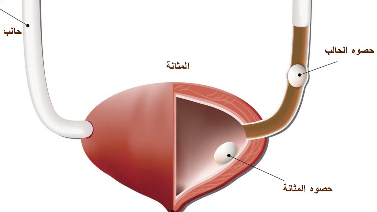 علامات نزول الحصوة- ازاي تعرفي ان دي حصوه 11476 1