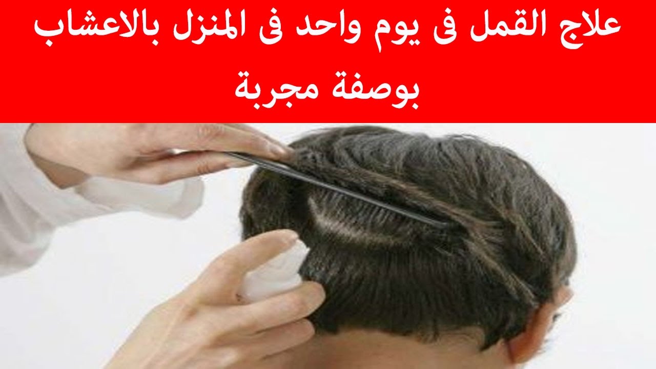 علاج القمل - القمل و طرق التخلص منه 3393 3