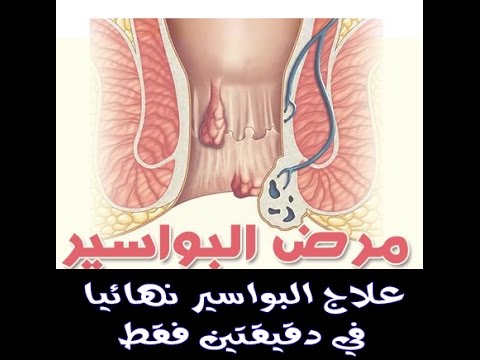 علاج البواسير , كيف تعالج البواسير