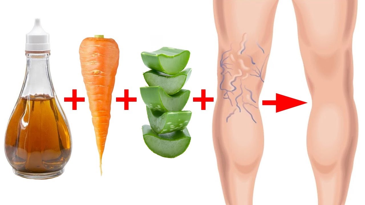 علاج الدوالي بخل التفاح - الحل السحري والفعال في علاج دوالي القدمين 12014 1
