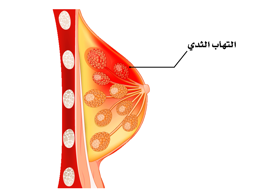 التهاب الثدي , يجب عليك الحظر