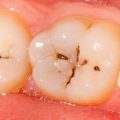 4798 3 علاج تسوس الاسنان - لماذا نصاب بتسوس الاسنان سلام فريد