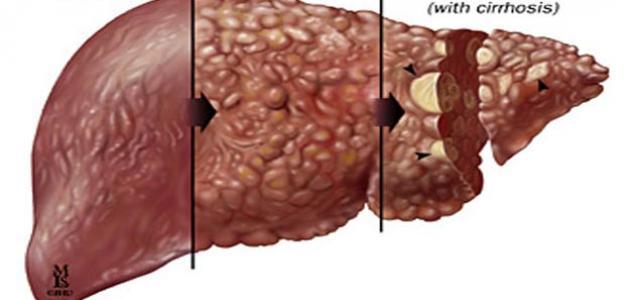 مرض الكبد الوبائي , تعرف على مرض الكبد الوبائى