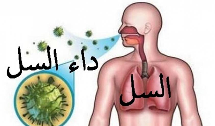 علاج مرض السل , تعرف على مرض السل و طرق العلاج منه