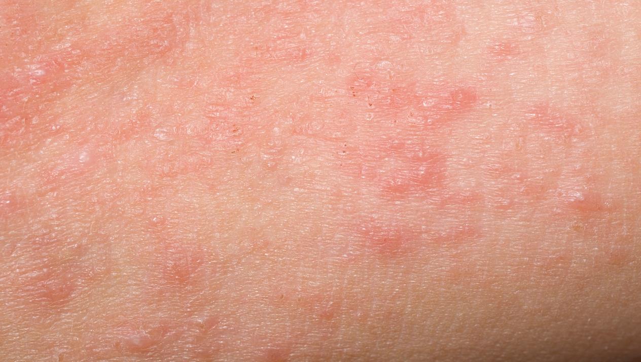 انواع الامراض الجلدية اسباب الامراض الجلدية المنام