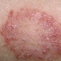 12283 3 انواع الامراض الجلدية - اسباب الامراض الجلدية U19