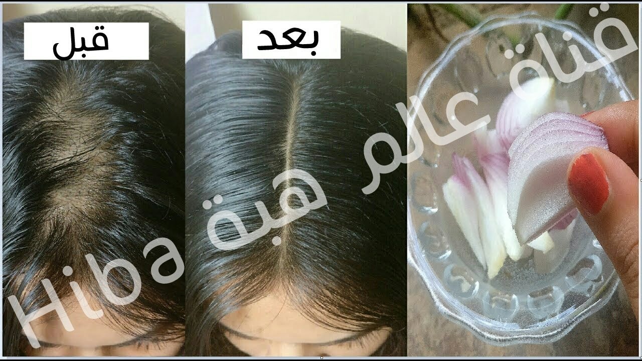 طرق انبات الشعر , وصفه رهيبه ومجربه